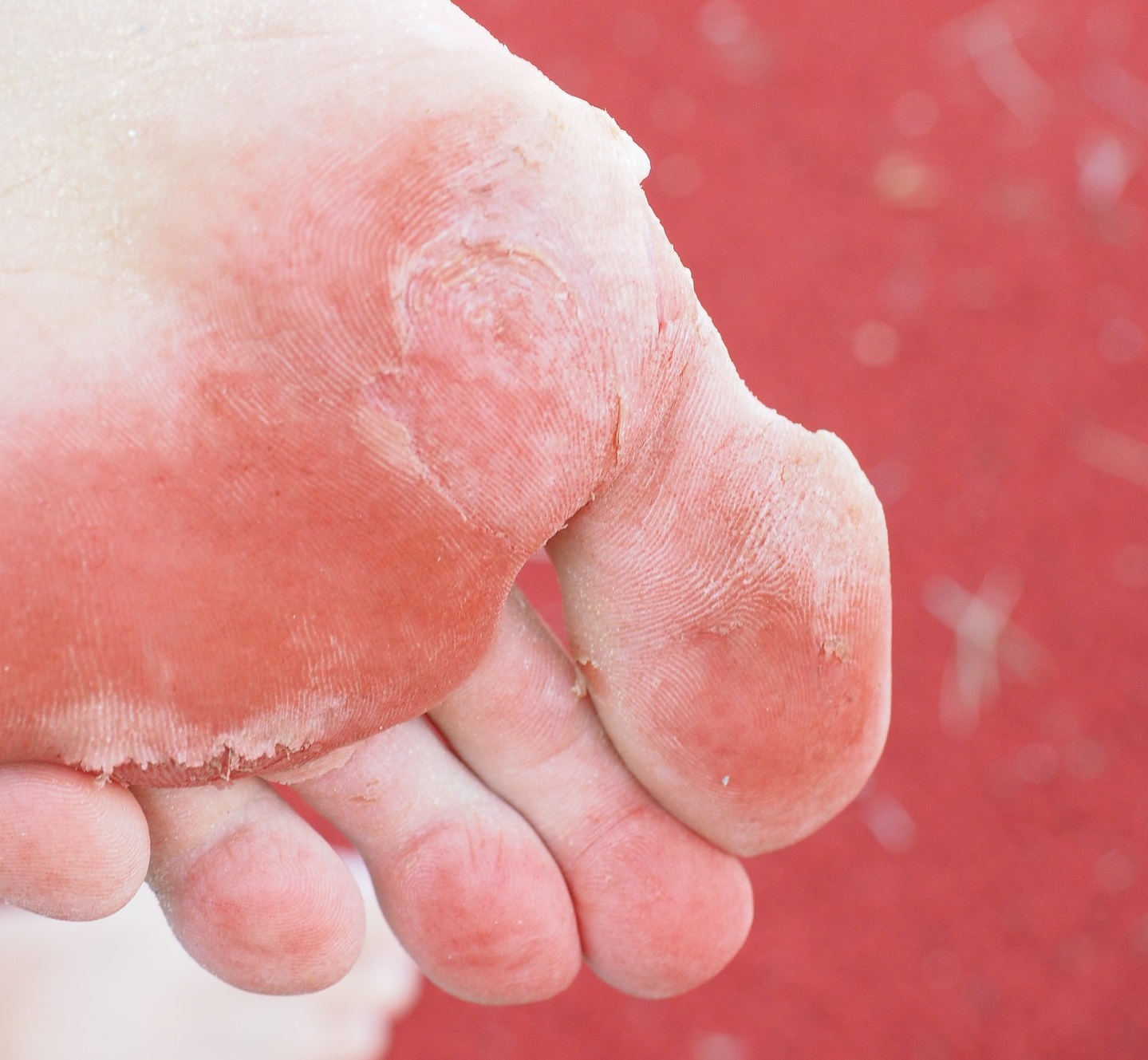 Hongos en los pies: por qué aparecen y cómo evitarlos